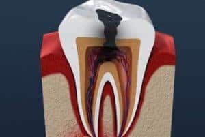 Root Canal Treatment