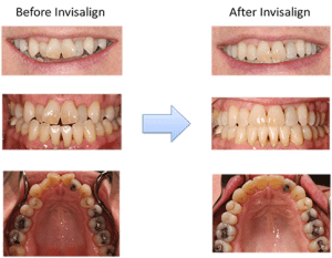 Invisalign Clear Aligners