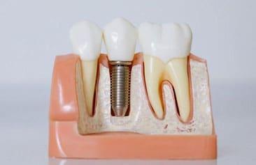 Implant Casa Dental