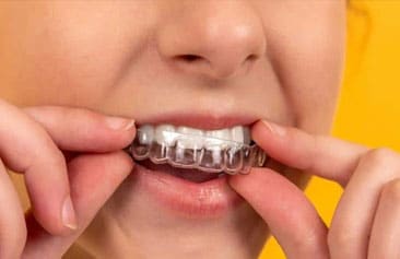 Teeth Whitening Casa Dental