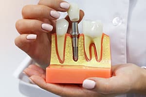 Dental Crown2 Casa Dental