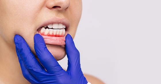 What Causes Bleeding Gums And When To See A Dentist